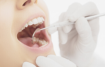 歯周病安定期治療（SPT）
