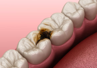 虫歯