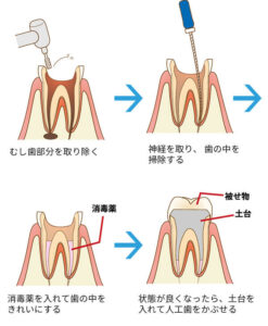 虫歯や歯周病などの進行度合