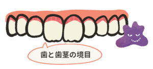 磨き残しが多いところー歯と歯茎の境目