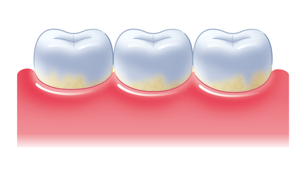 お口のトラブルを予防・改善して口臭を予防しよう | 川西能勢口駅から徒歩1分の歯科・歯医者｜福地歯科クリニック