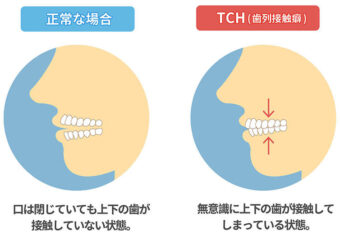歯列接触癖TCH